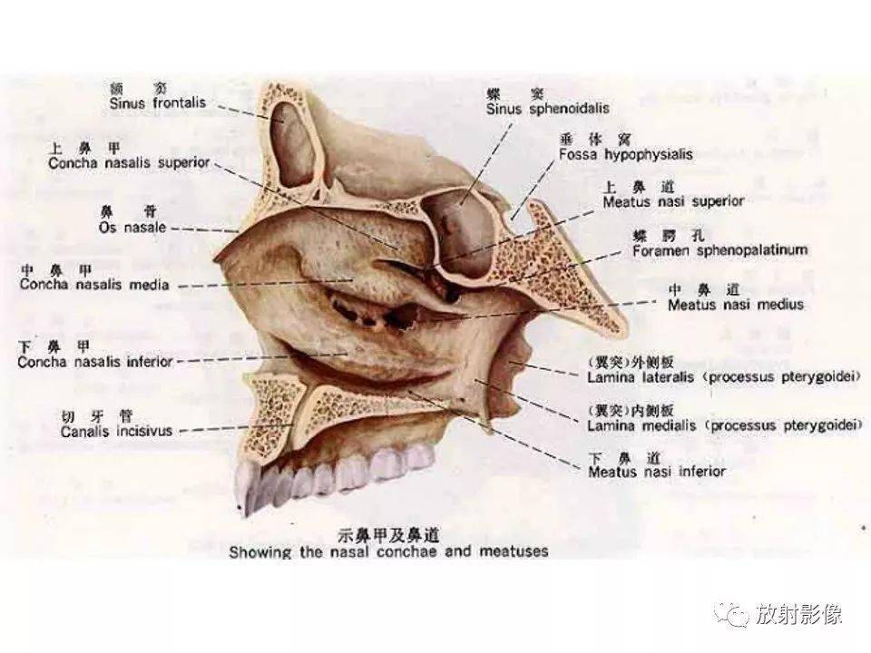 寫鼻竇報告千萬要注意這個解剖結構_病變_邢振_平臺