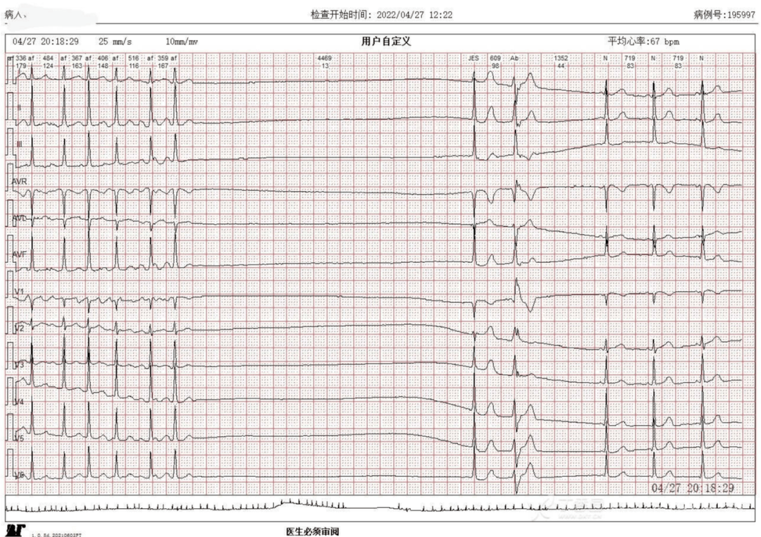 房颤心电图 波形图片