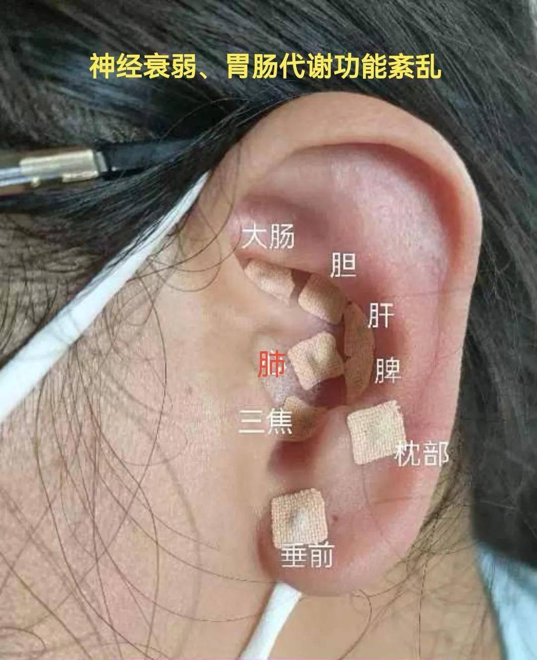 耳穴压豆治疗优势病