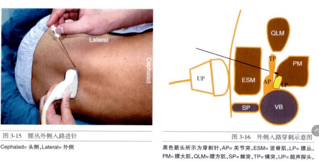 腰麻旁正中入路图解图片