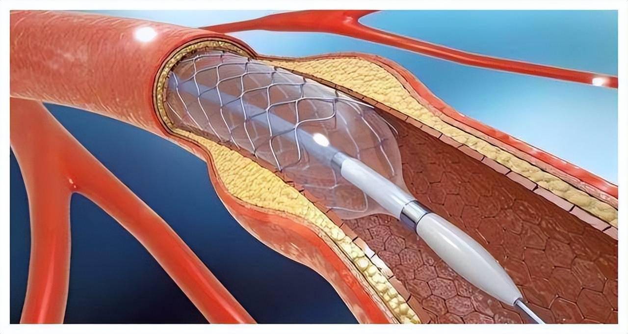 心脏支架2万降至700为何手术费还这么贵光它降低可没用