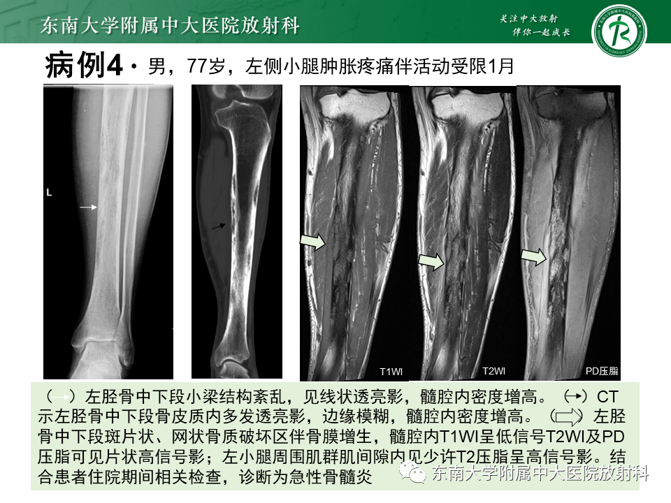 骨梗死影像表现