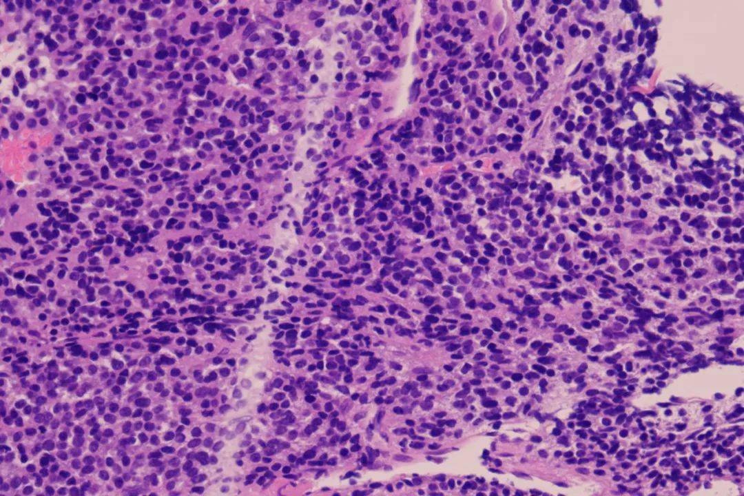 多发性骨髓瘤血片图片
