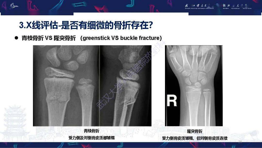 儿童肘关节x片骨骺图片