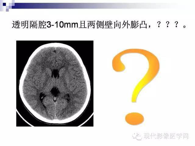 9岁儿童透明隔腔增宽图片