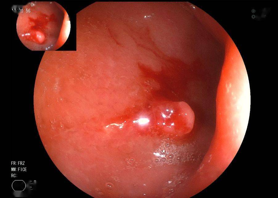 十二指肠降部息肉图片