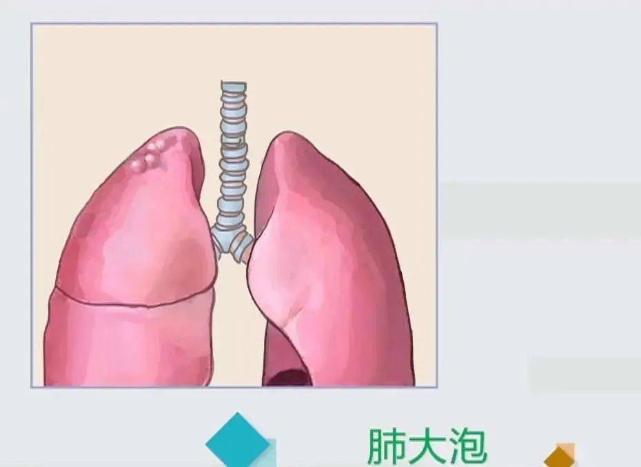 气胸 偏爱瘦高个子 治疗 患者 肺部