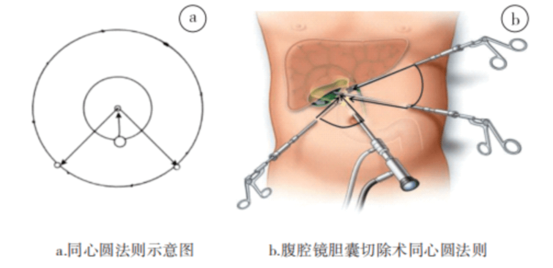 腹腔镜trocar位置图片