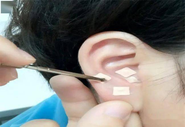 中医特色小豆子大作用贴耳朵来看病