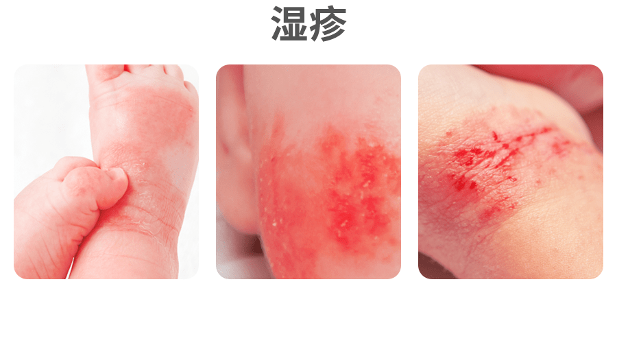 湿疹和痱子分不清1招教你轻松辨别