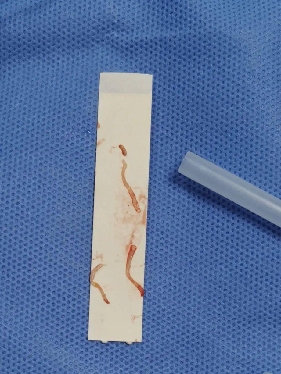 术中超声引导下实时观察穿刺针位置超声科杨文艳主任及韩阳医生为患者