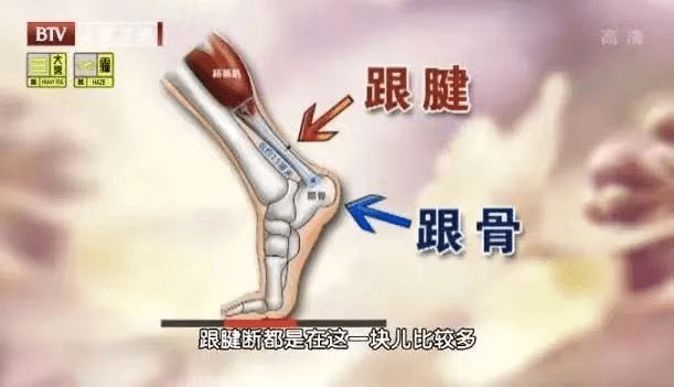导致跟腱炎的危险因素①长期反复高频的跑跳运动,跟腱会反复受到牵拉