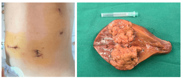 肝母细胞瘤肚子图片图片