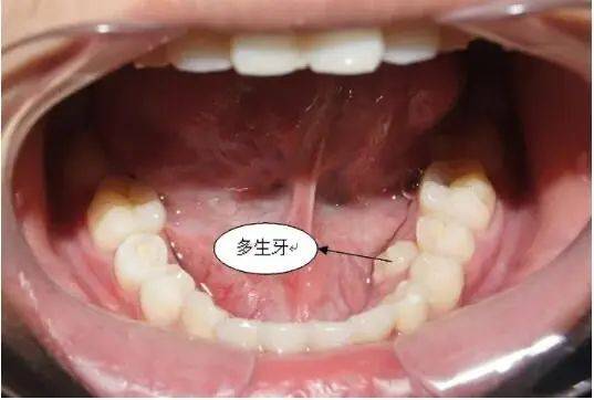 因多生牙可能会影响正常牙齿的萌出,进而影响正常牙齿排列,所以医生