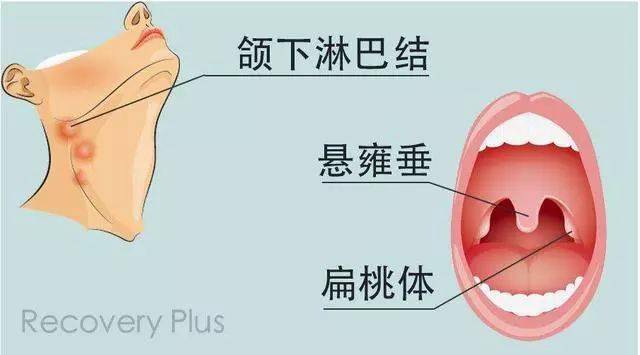 扁桃体和淋巴结的位置图片