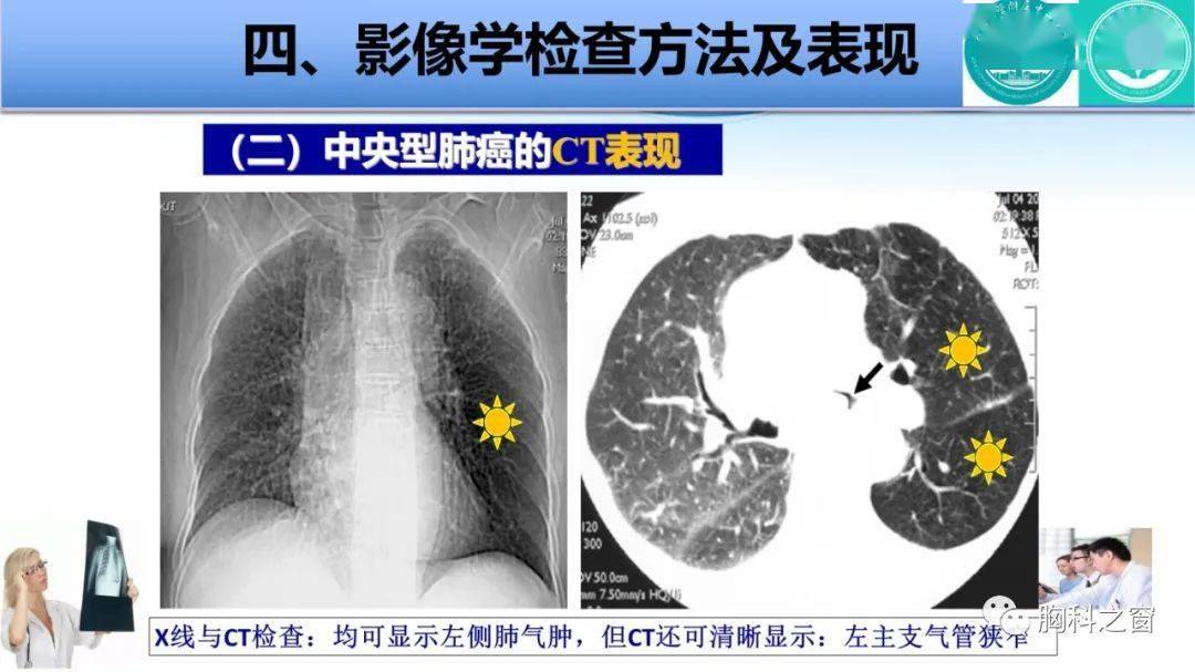 中央型肺癌影像学图片