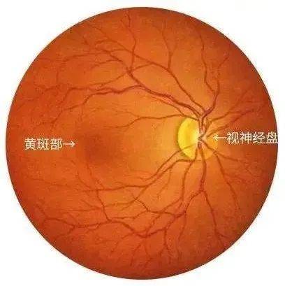 眼底“扫黄”，警惕“变性”——一图自测_黄斑_视网膜_屈光