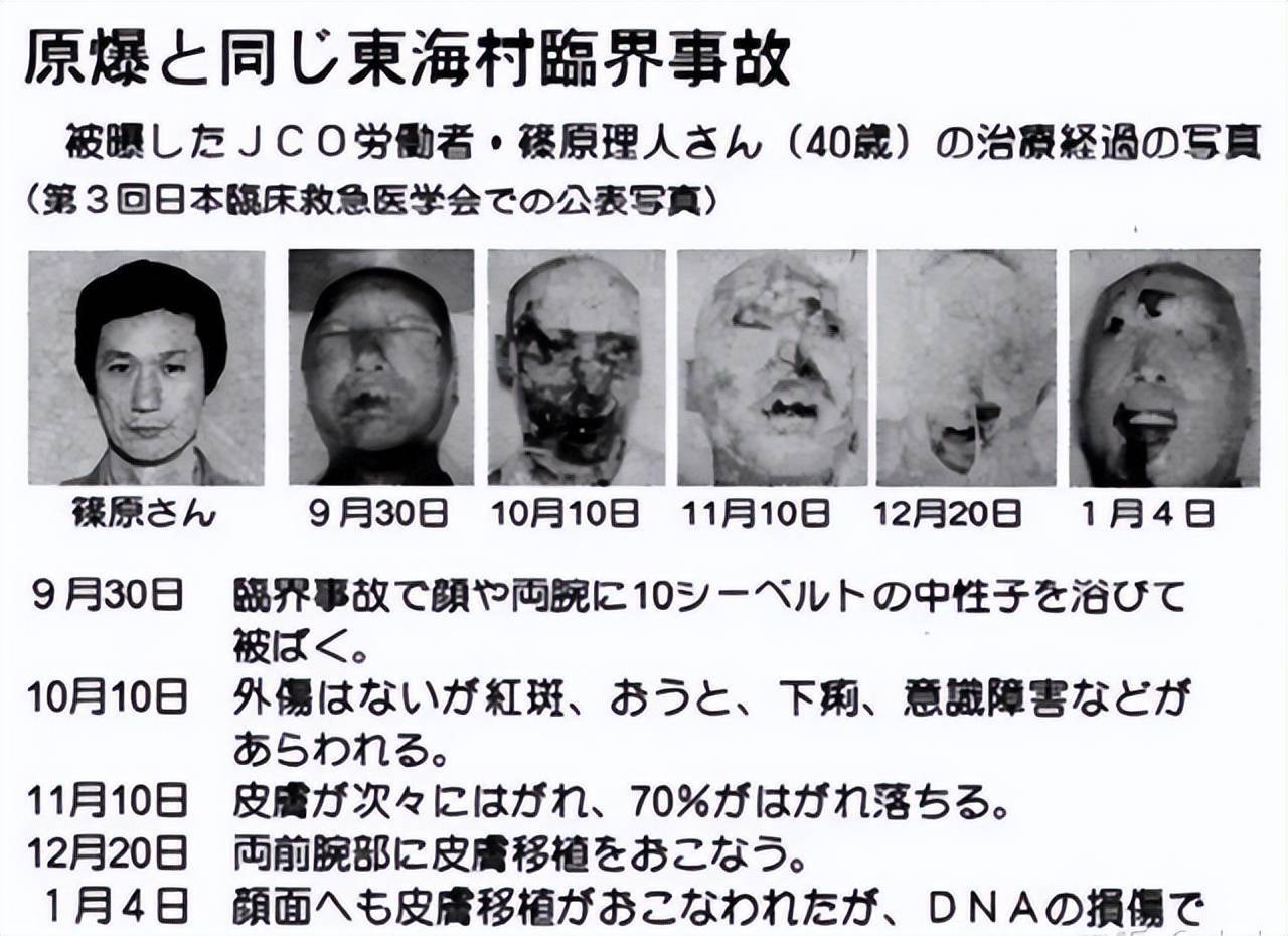 1999年日本核临界事故,男子染色体断裂皮肤脱落,结局比凌迟还惨