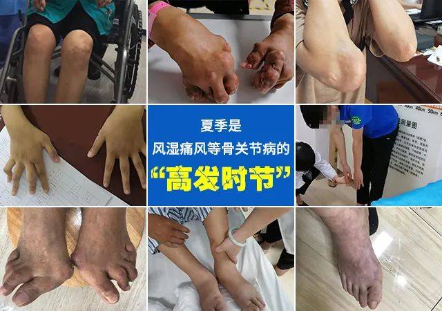 河南痛风风湿骨病患者快申领7月这项慢病补贴来了