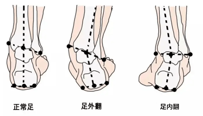 足外翻通常情况下属于旋前状态,足踝旋前时通常骨盆旋前股骨内旋,胫骨