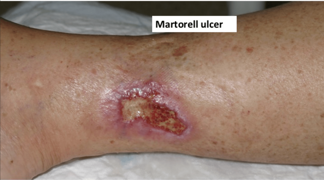 对于martorell溃疡这些关键因素你必须了解