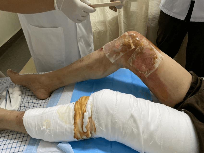 夏季烫烧伤频发,这些急救小方法你需要掌握_皮肤_大伯_治疗