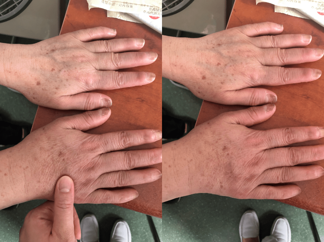 手术后怎么手肿了带你认识乳腺癌相关上肢淋巴水肿