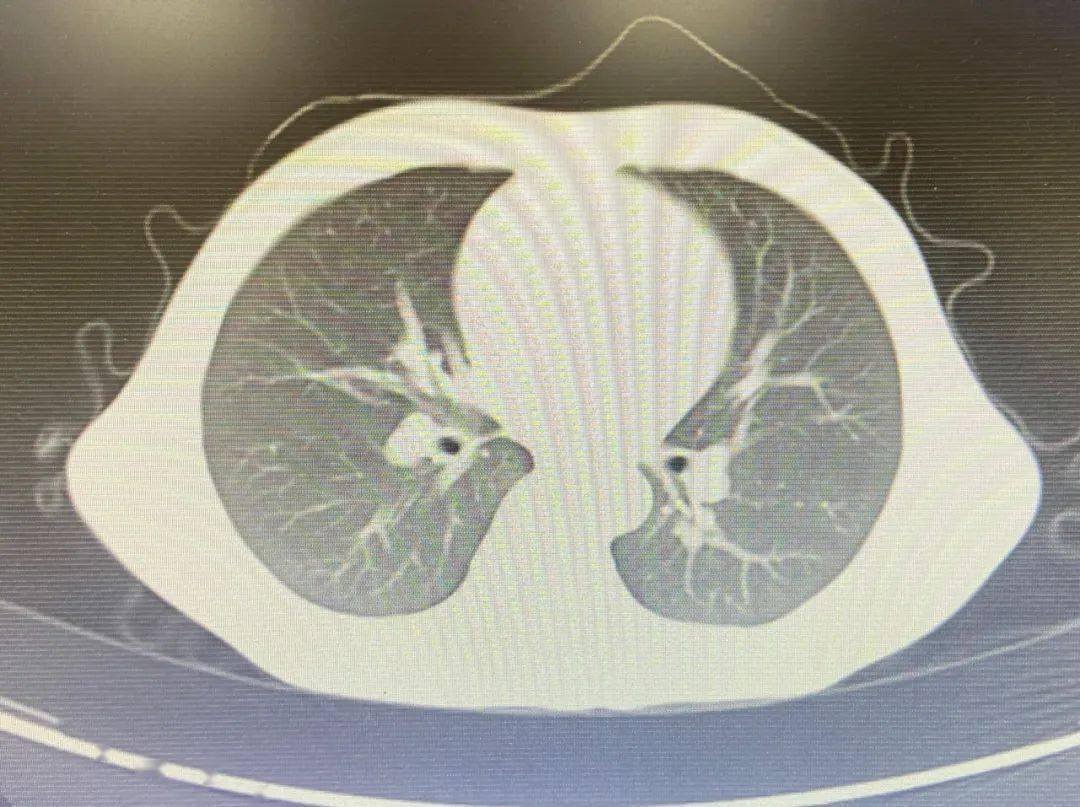 支气管镜检查:双肺支气管各段粘膜充血,肿胀,可见纵行皱褶,支气管灌