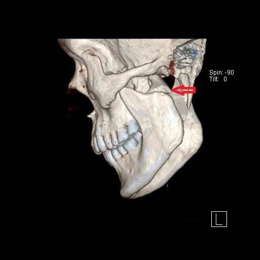 下颌骨髁突骨折图解图片