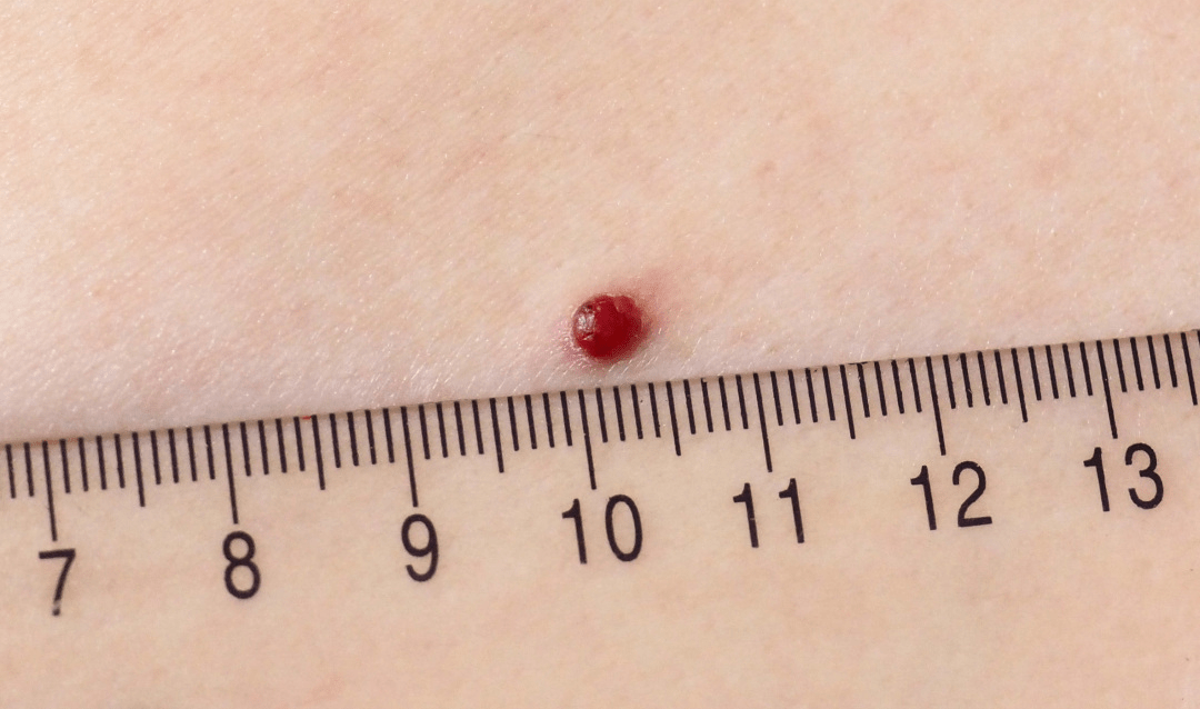 肝癌早期的红痣图片图片