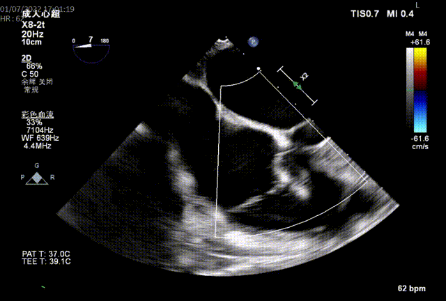 图3：术后即刻tee三尖瓣反流 (tricuspid regurgitation,tr) 是常见的心