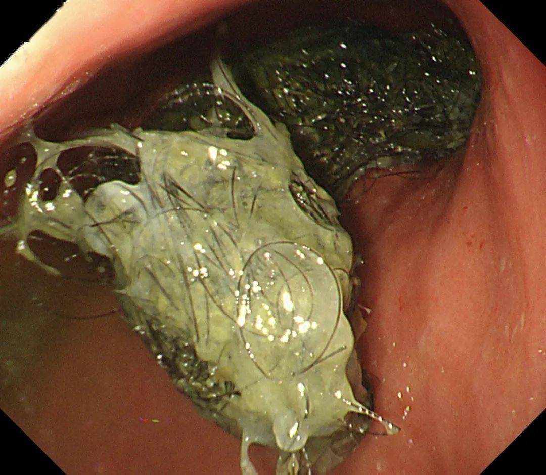 顺德5岁女孩腹痛难忍医生一查震惊了胃里竟发现