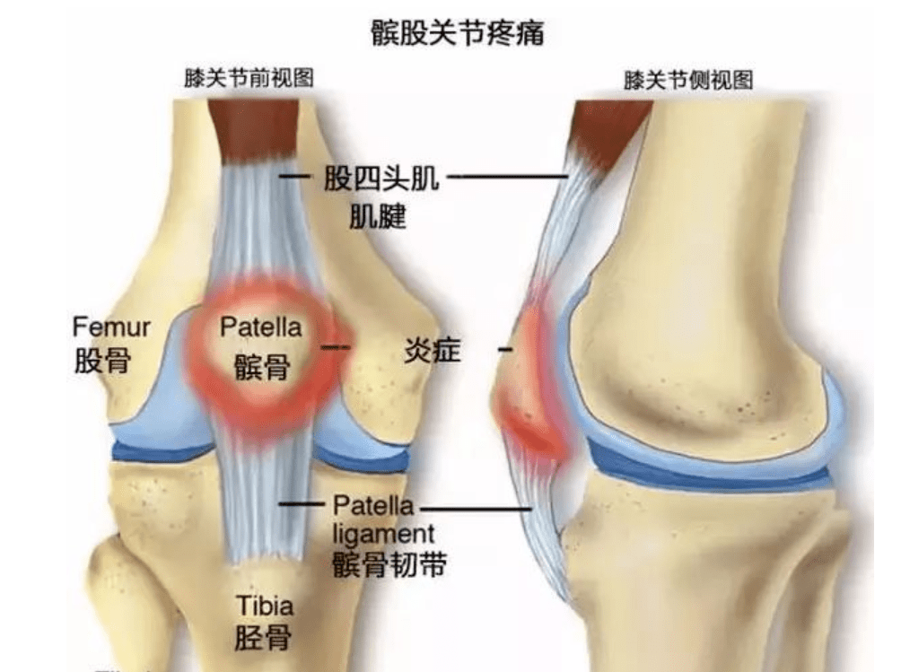 上端內側幹骺端部: 骨軟骨瘤髖關節疾病引發膝內側痛(閉孔神經支配)