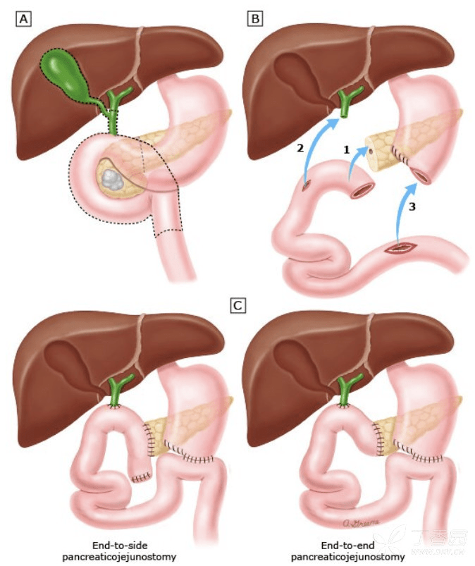胆肠吻合图片