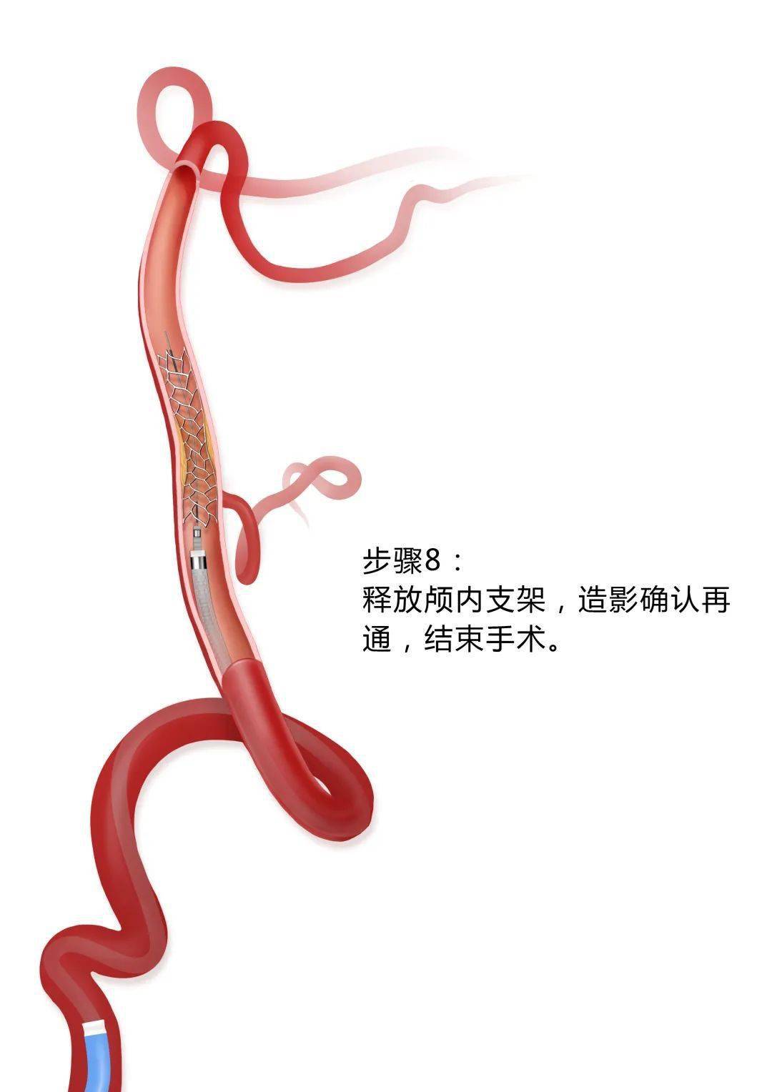 探囊取物丨陈文伙教授：ICAS-LVO处理新策略—BASIS技术详解_支架_血管_患者