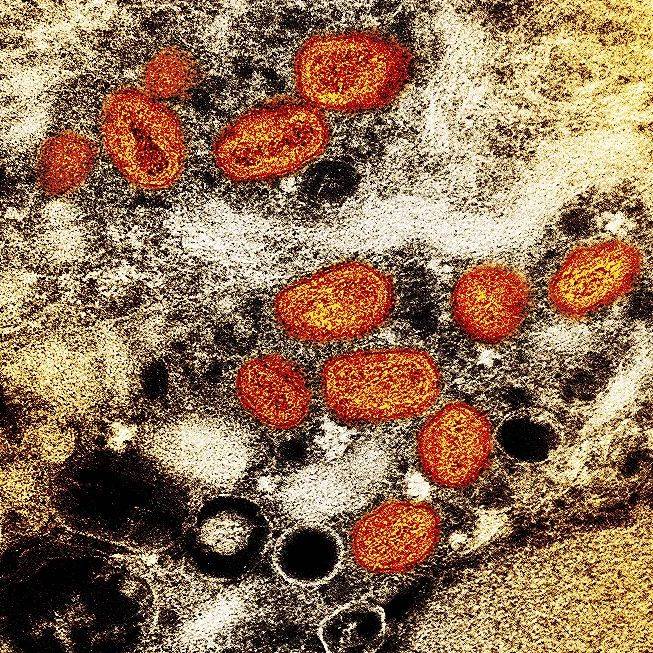 美国猴痘确诊数已全球第一，纽约州进入“灾难紧急状态”！两国出现死亡病例，系非洲之外首次