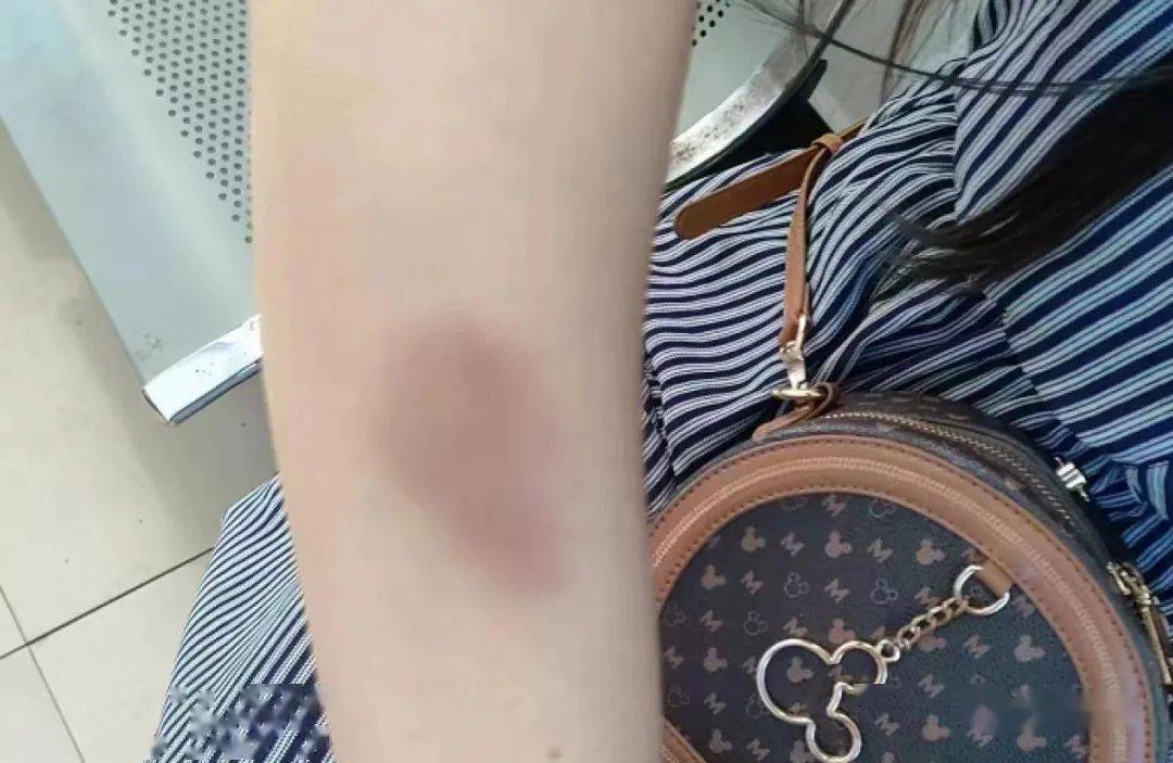 民警蒋三友见郑女士双眼肿胀,几乎无法睁开,胳膊和手背有好多处青紫