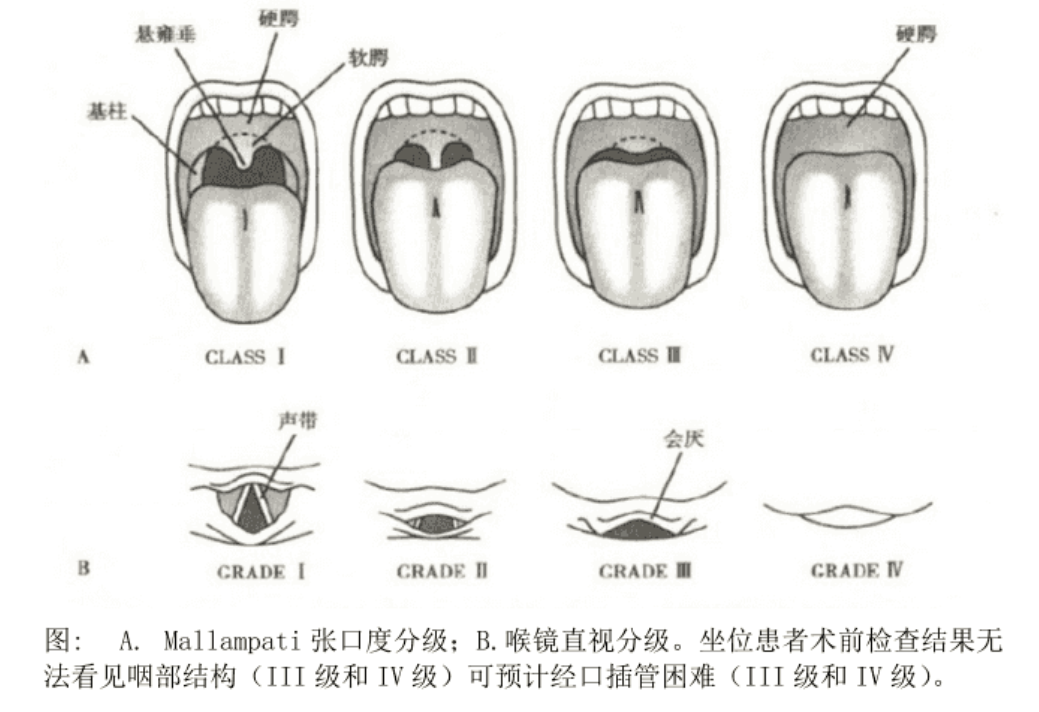 甲颏间距:头后仰,测量甲状软骨上切迹到下颏的距离,甲颏间距 6 cm