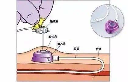 健康手臂港肿瘤患者静脉输液的生命线