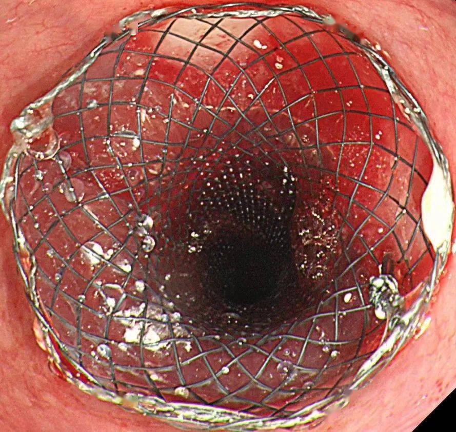 食道癌食道支架图片图片