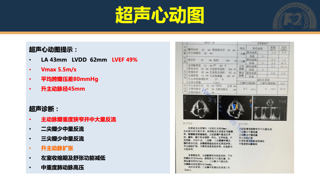 患者资料基本情况,既往病史,合并症,sts评分和nt-probnp:入院超声心动