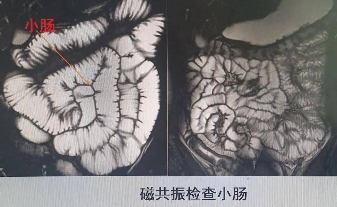 磁共振机下的钡餐透视您见过吗?