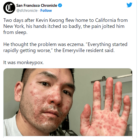 亚裔男染猴痘以为是湿疹红点急扩散睡觉被痛醒