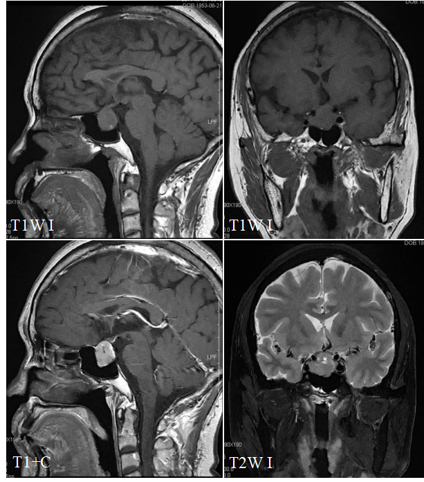 垂体瘤核磁共振图片图片