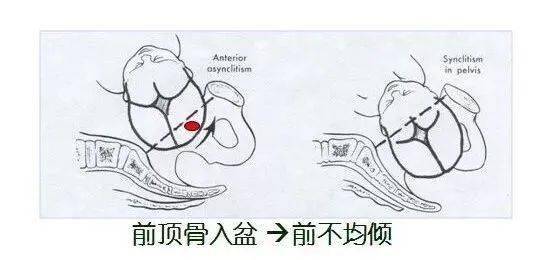 胎儿以枕横位入盆(胎头矢状缝与骨盆入口横径一致)时,胎头侧屈,以前顶
