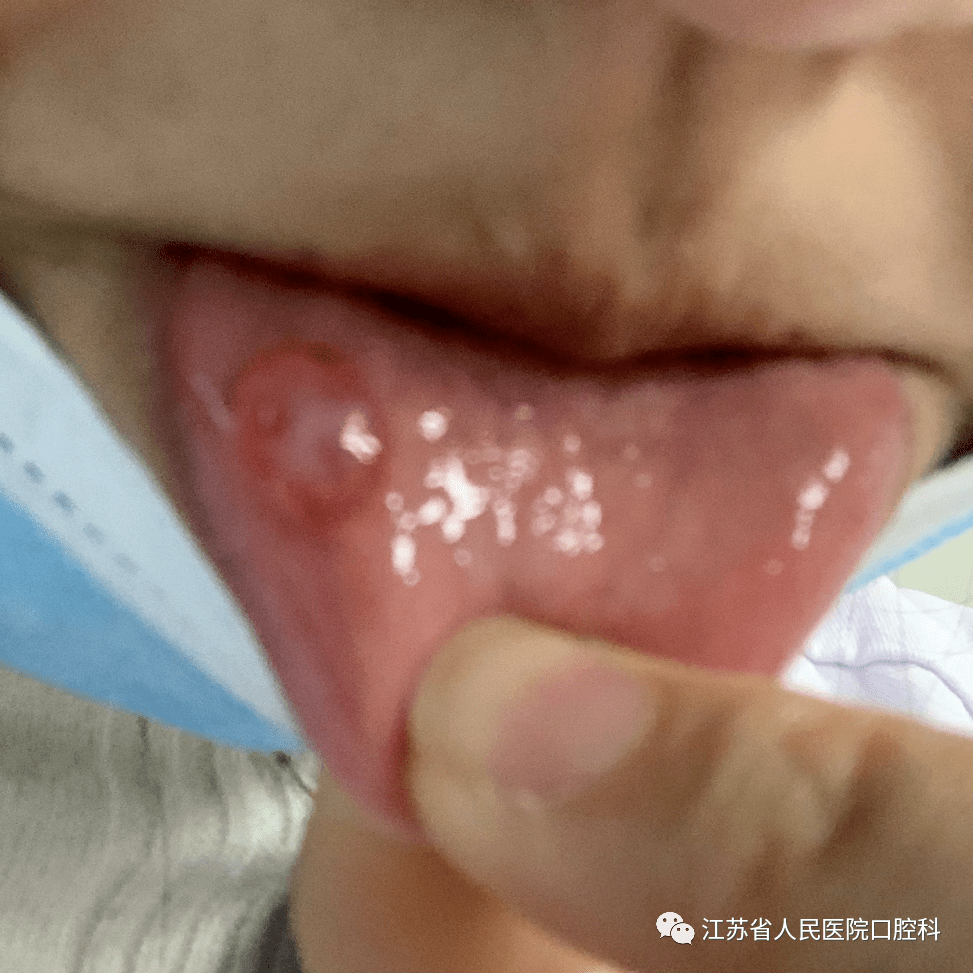 浅谈唾液腺囊肿