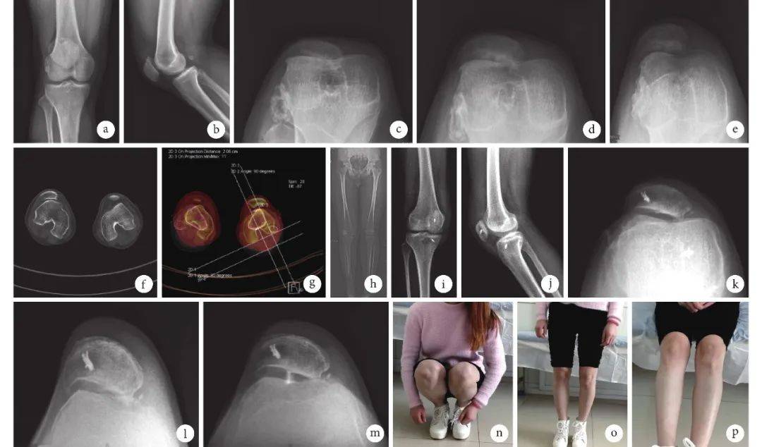 术前右髌骨轴位(30,60,90)x 线片;f,g.