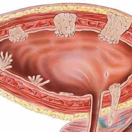膀胱息肉与膀胱癌图片图片