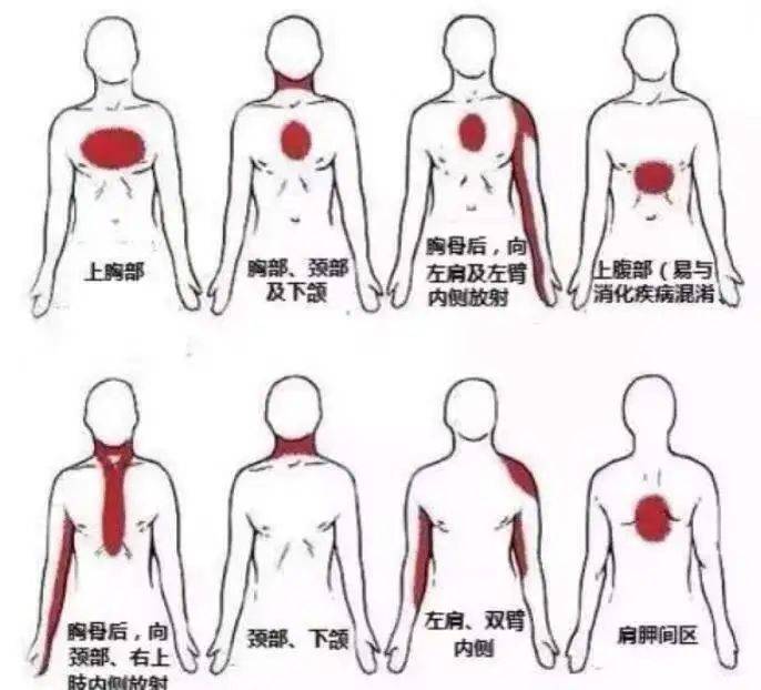 这些疼痛不是心绞痛,需要速查其他原因!_心脏_部位_活动