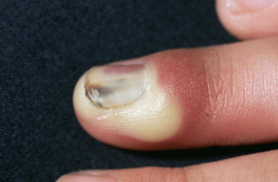 徐州名松堂中医科普:甲沟炎|得了甲沟炎并不可怕,化脓性甲沟炎也可防